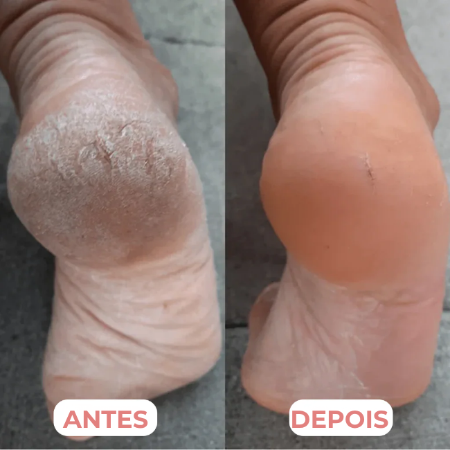 🌟 PédiBrilho + 60 discos: Pés macios, suaves e irresistíveis em poucos minutos! 👣✨